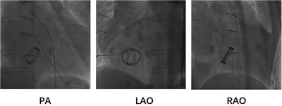 A case report of left ventricular lead implantation via total three-dimensional transseptal puncture after tricuspid valve replacement